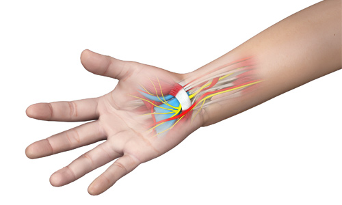 What Is Carpal Tunnel Syndrome and How Can You Treat It? - Live Well  Chiropractic Center